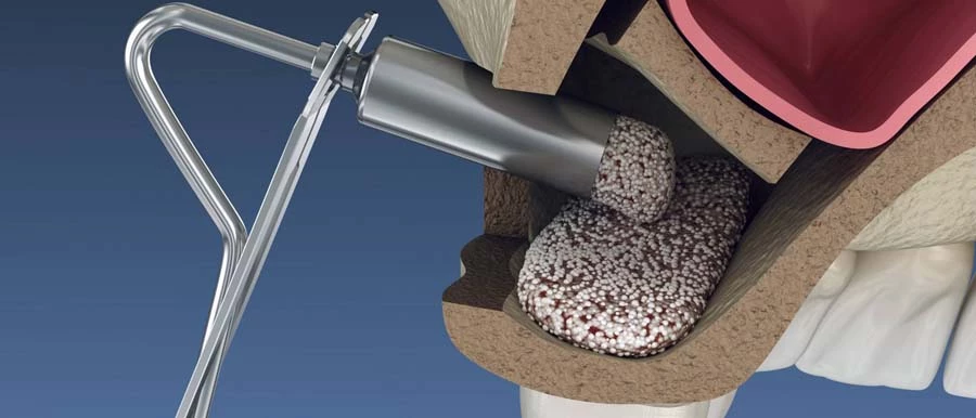 Csontpótlás sinus lift