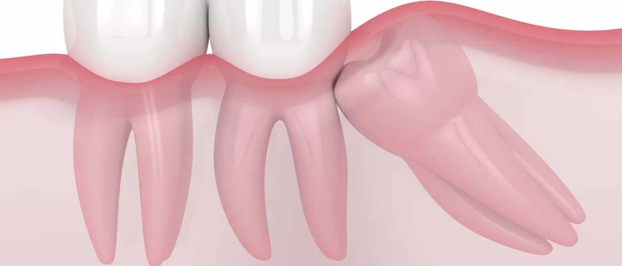 Bölcsességfog ferdén nő