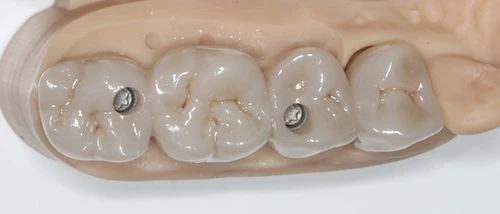 Csavaros fog beültetése