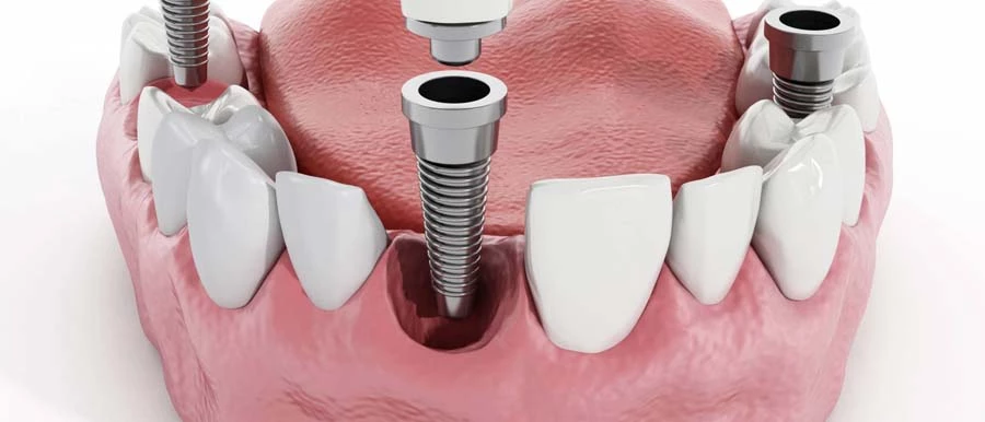 Csontpótlás után fogbeültetés