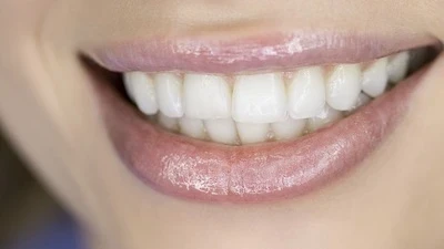 Esztétikai fogászat eredmény