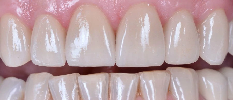 Esztétikus fémmentes korona