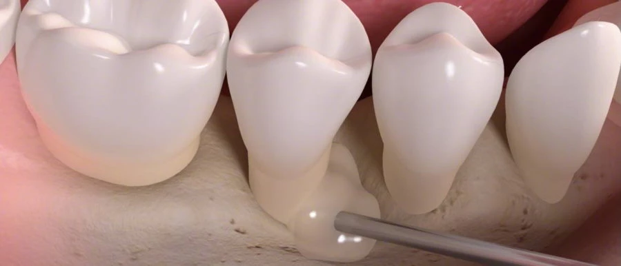 Fogínysorvadás kezelése regenerációs műtét