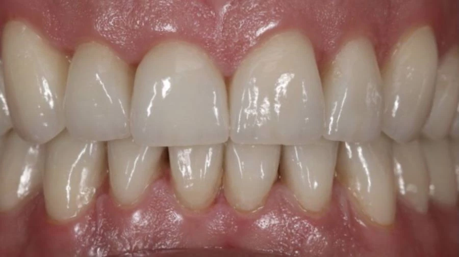 Esztétikai fogpótlás