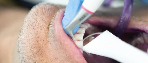 Fogtisztítás guided biofilm therapy