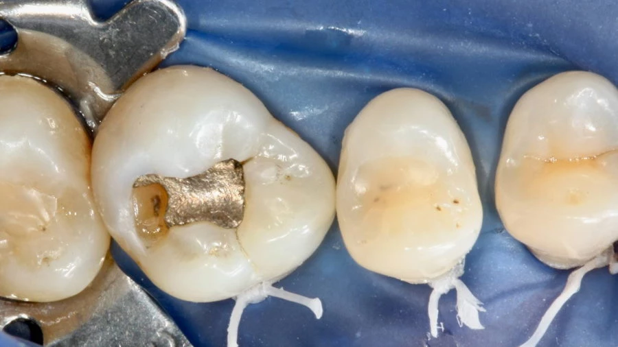 Amalgám tömés cseréje