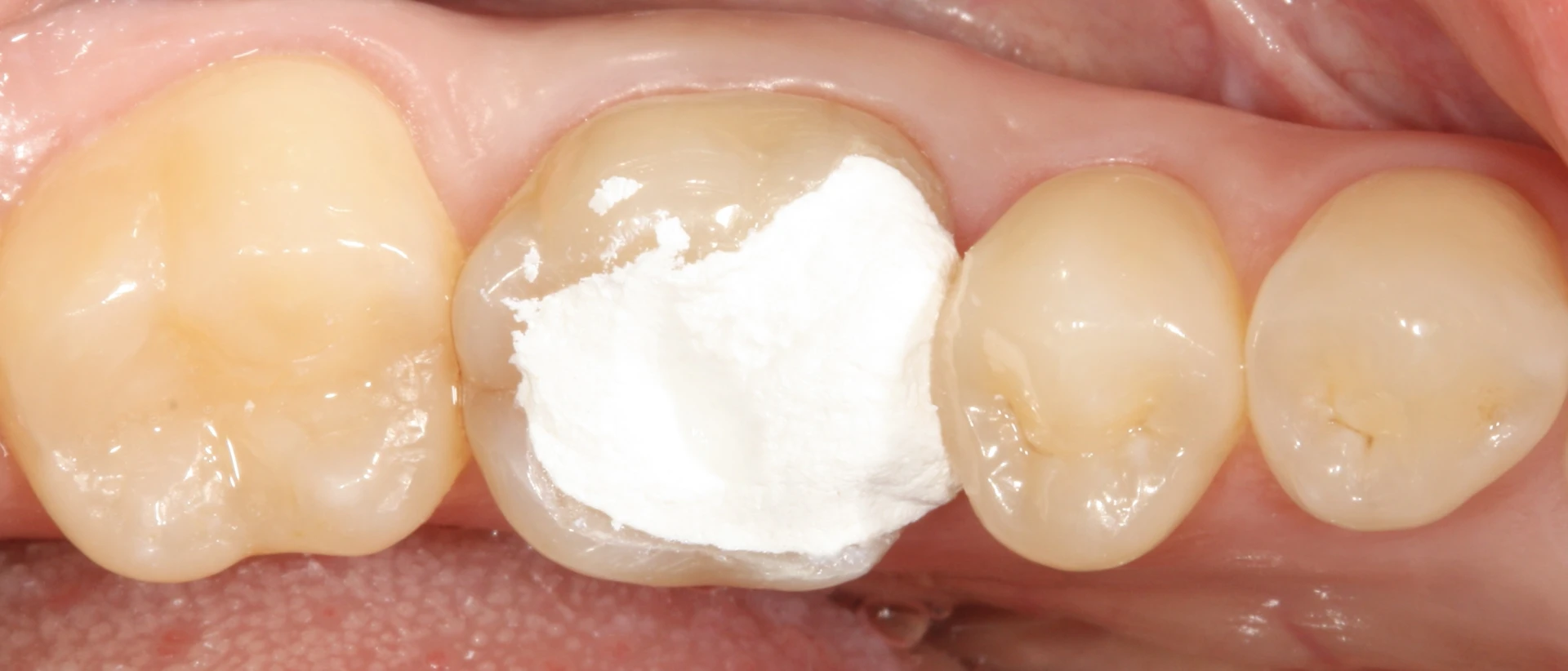 Ideiglenes tömés kiesett