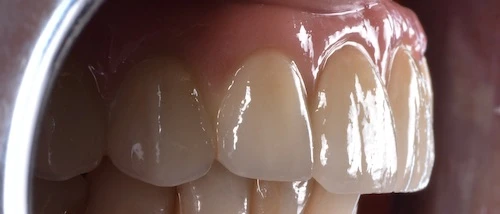 implantációs fogpótlás