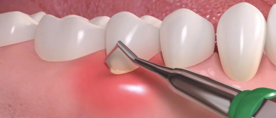 Fogínysorvadás kezelése zárt küret