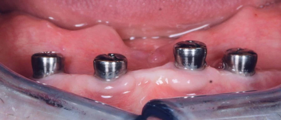Fog implantátum gyógyuló csavar