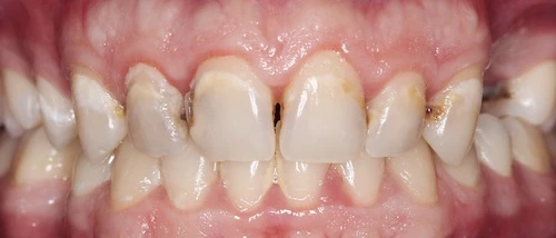 Íngyulladás képe, lepedék