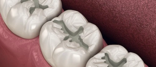 Kiterjesztett barázdazárás