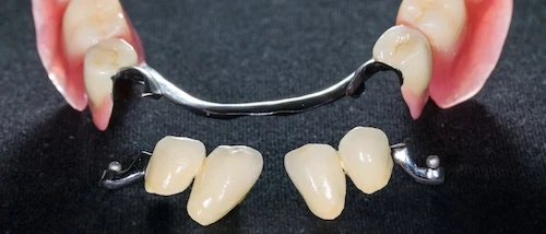 Patentos fogsor képe