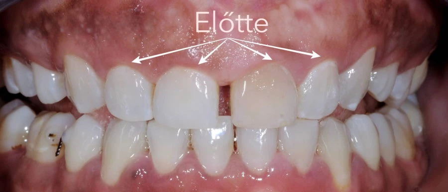 Koronahosszabbító műtét előtt