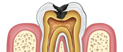 miért alakul ki a fogfájás tömés után