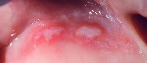 nagy aftás fekély képe