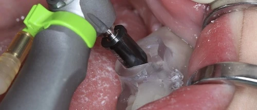 Implantációs sablon