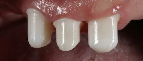 teleszkópos fogsor képe