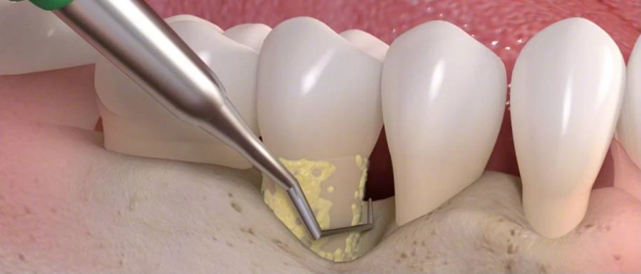 Fogínysorvadás kezelése nyitott küret